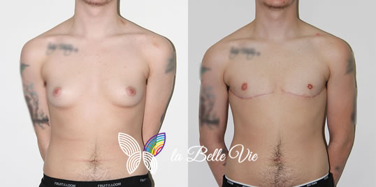 Top surgery Before After Photo, Dr. Tony Mangubat