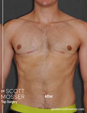 FTM Top Surgery Before and After Photos - Dr. Scott Mosser