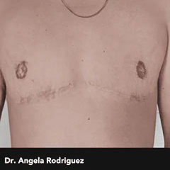 Double Incision Top Surgery