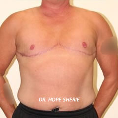 Dr. Hope Sherie Top Surgery Results