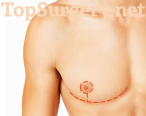 Inverted-T / T-Anchor Top Surgery