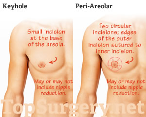 Keyhole and Peri-Areolar Top Surgery compared