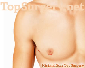 Minimal Scar Top Surgery by Dr. Elliot Jacobs