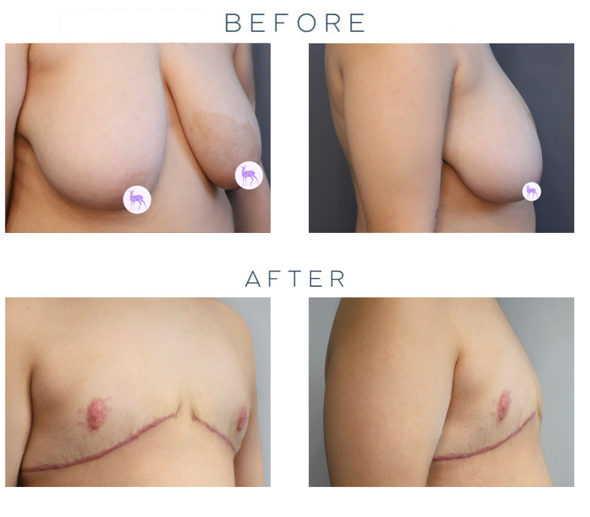 Top Surgery Before and After Photos by Dr. Aneesh Gupta, Philadelphia, Pennsylvania