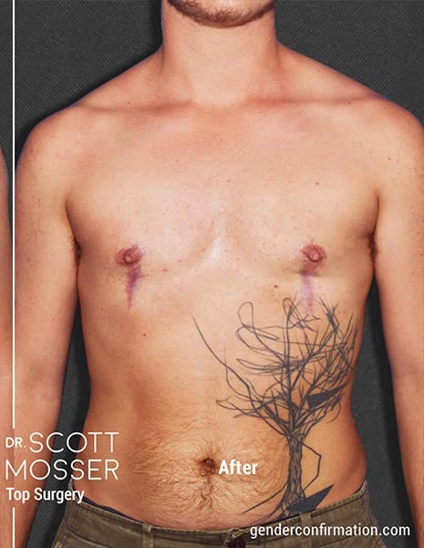 Dr. Scott Mosser - San Francisco's FTM/N Top Surgery Expert.
