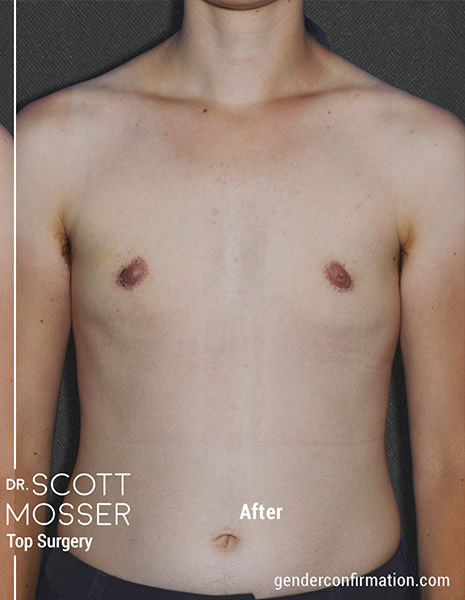 Dr. Scott Mosser - San Francisco's FTM/N Top Surgery Expert