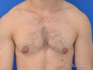 Dr. Thomas Satterwhite - FTM Top Surgery California