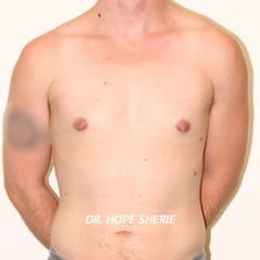 Top Surgery Before and After