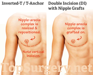 Invertido-T e a Dupla Incisão Superior a Cirurgia comparado