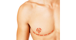 Top Surgery Cost: Find Out How Much Top Surgery Costs
