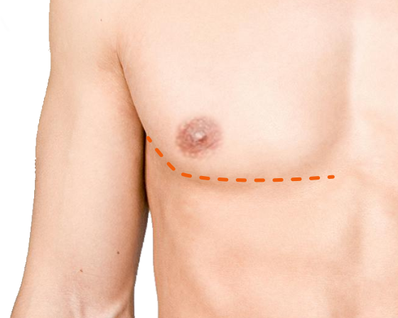 Nipple-Preserving Inferior-Ellipse Mastectomy