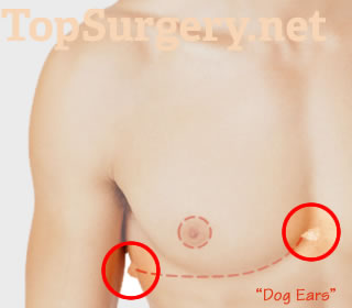 Top Surgery and Dog Ears