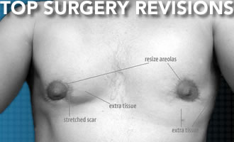 Top Surgery Revisions: Stats, Causes, Costs and Tips