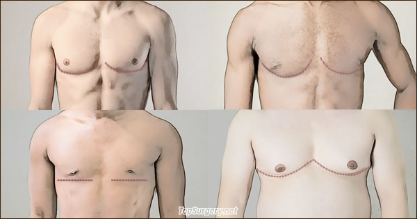 Top Surgery Scar Shapes - Types of Double Incision Scars
