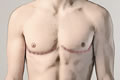 Double Incision Top Surgery Scar Shapes