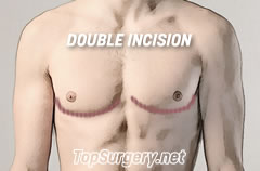 Top Surgery Scars - Double Incision