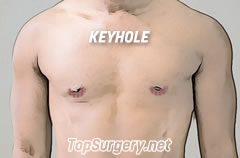 Top Surgery Scars - Keyhole