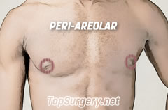 Top Surgery Scars - Periareolar