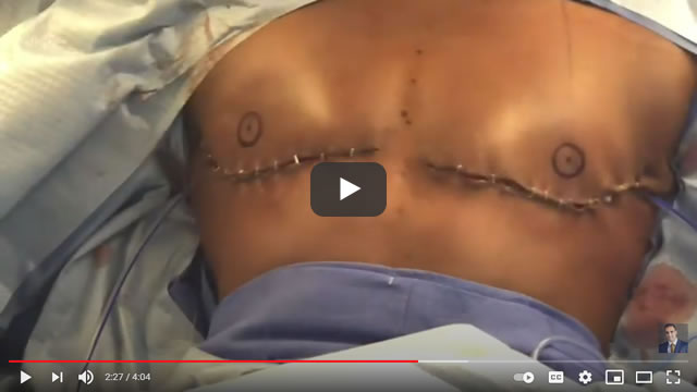 Double Incision Top Surgery