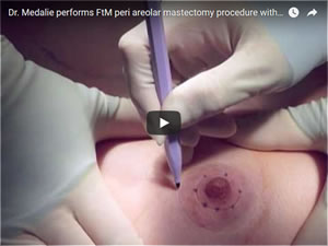 OR Video: Peri-Areolar Top Surgery