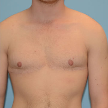 Top Surgery result