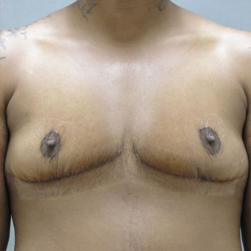 Top Surgery result