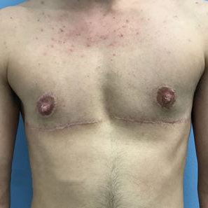 Top Surgery result