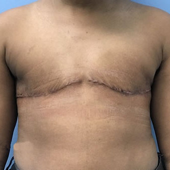 Top Surgery result