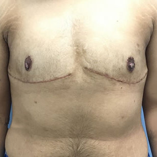 Top Surgery result