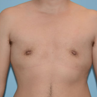 Top Surgery result